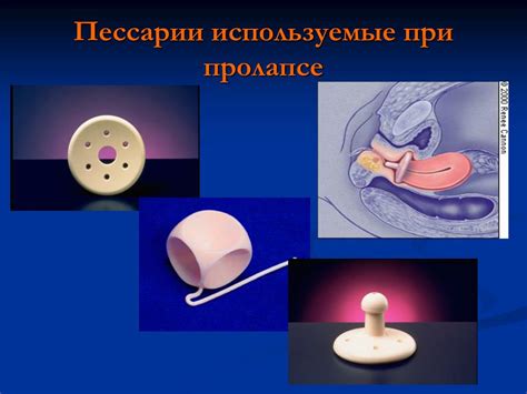 Профилактика пролапса и инконтиненции