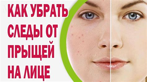 Профилактика прыщей на сосках: советы для поддержания здоровой и красивой кожи