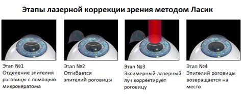 Процедура лазерной коррекции зрения: когда использовать телефон