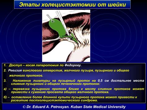 Процедура холецистэктомии от дна