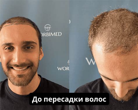 Процесс проведения пересадки