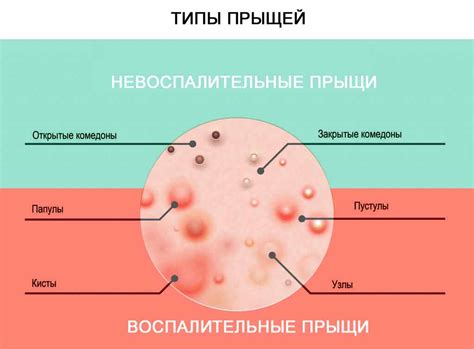 Прыщи на сосках: влияние на самочувствие и внешний вид