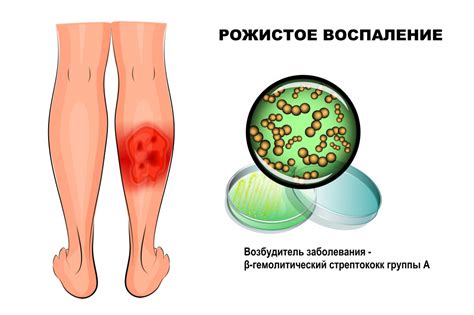 Пути передачи рожистого воспаления