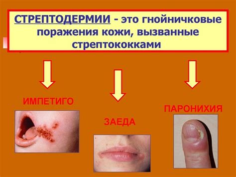 Пути передачи стрептодермии у детей