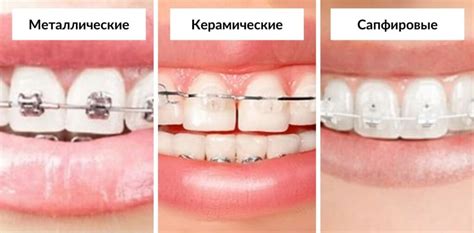 Различные типы брекетов для верхней челюсти: сравнение
