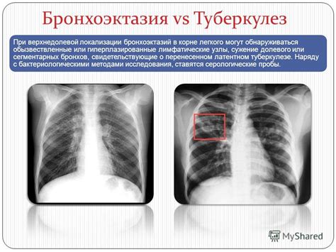 Разница между флюорографией и КТ