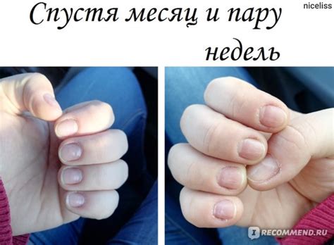 Разрушение зубов и ногтей при недостатке кальция