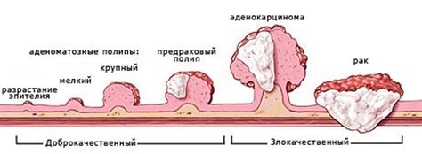 Раковые опухоли