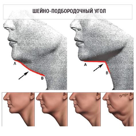 Распознавание типов второго подбородка