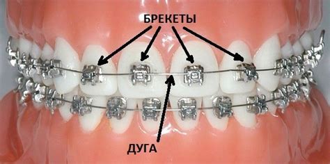 Рекомендации по чистке зубов после снятия брекетов