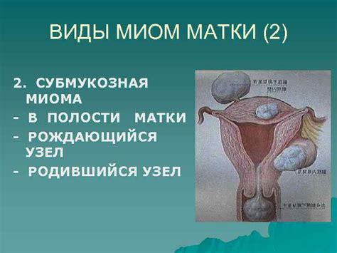 Риски и ограничения при установке спирали при наличии миомы матки