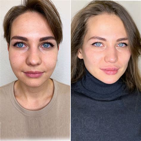 Риски колоть филлеры вокруг глаз