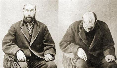Риски снятия скальпа