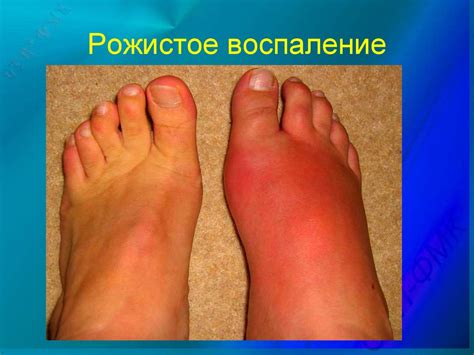Рожистое воспаление без повышенной температуры
