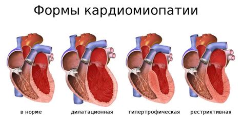Роль сжатия систолического шума в лечении гипертрофической кардиомиопатии