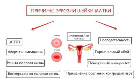 Роль спирали при эрозии шейки матки