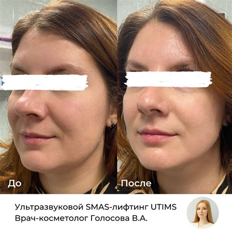 СМАС лифтинг и его эффект