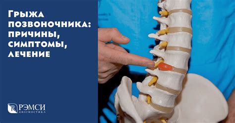 Связь между грыжей позвоночника и повышением температуры