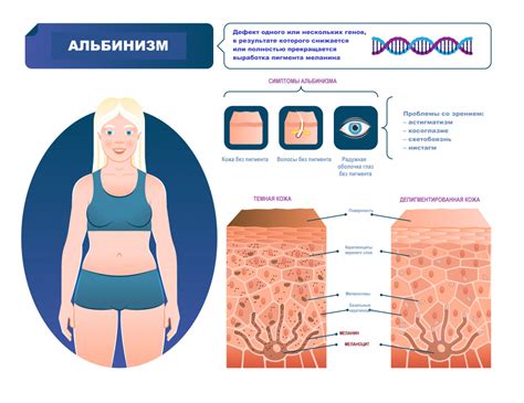Симптомы альбинизма