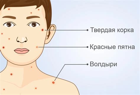 Симптомы ветрянки без сыпи