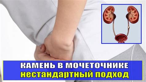 Симптомы выпадения стента из мочеточника