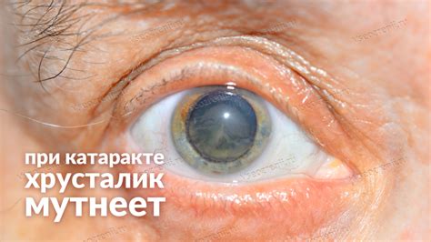 Симптомы жировика внутри глаза