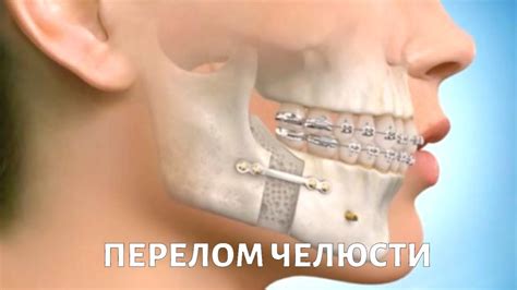Симптомы защемления челюсти слева