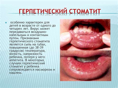 Симптомы и виды стоматита