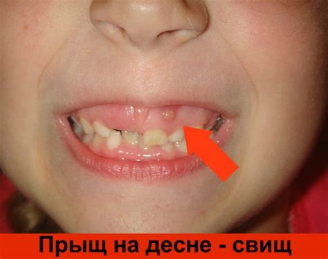 Симптомы и диагностика прыщиков во рту