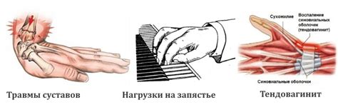 Симптомы и причины возникновения растяжения на руке