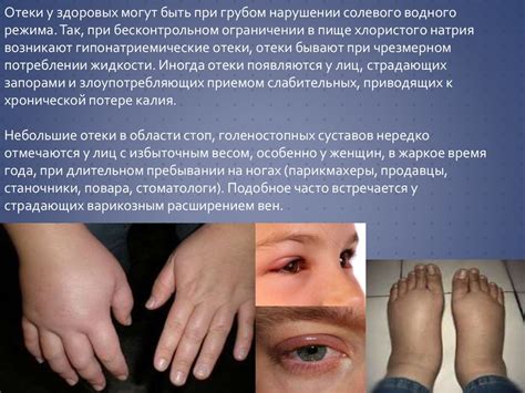 Симптомы и причины отеков
