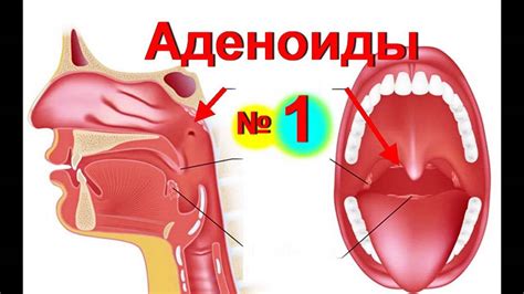 Симптомы повторного увеличения аденоидов