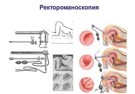 Симптомы рецидива свища