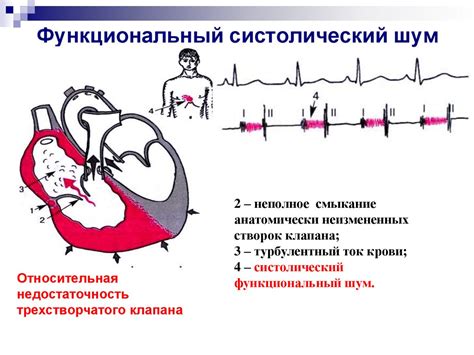 Систолический шум: причины и возможности сжатия