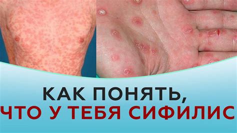 Сифилис: симптомы и проявления