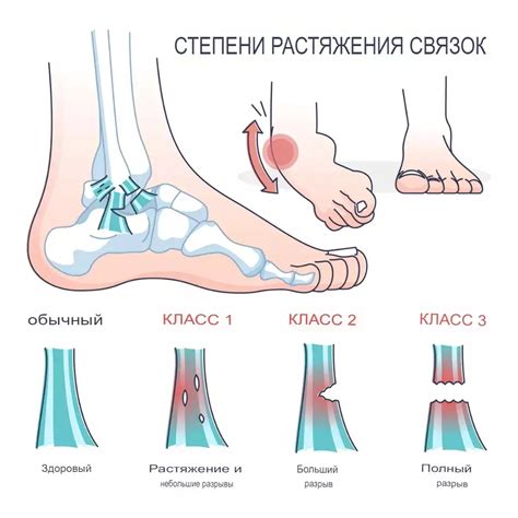 Скорая помощь при растяжении связок