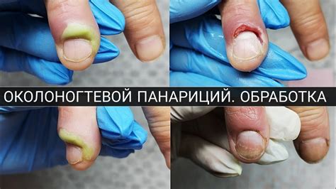Советы и рекомендации при воспалении пальца