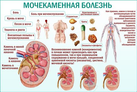 Соевый соус и мочекаменная болезнь: важная информация
