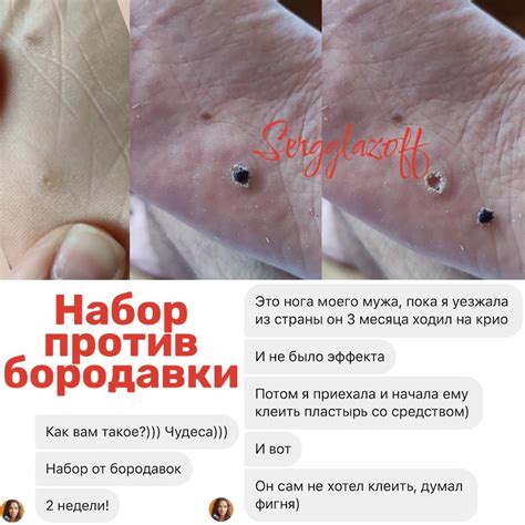 Способы борьбы с бородавками с помощью хозяйственного мыла