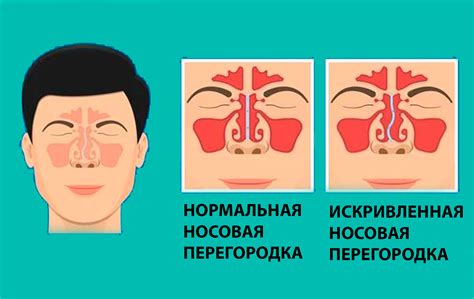 Способы промывания носа при искривлении перегородки