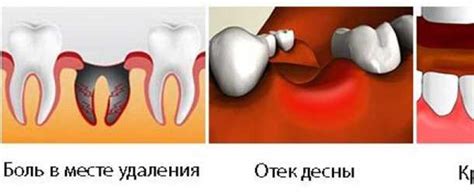 Сроки заживления десен после снятия швов