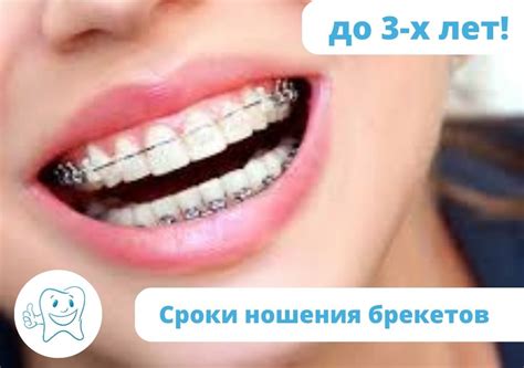 Сроки и особенности ношения брекетов на верхней челюсти