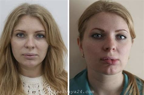 Сроки и стоимость удаления ботокса из губ