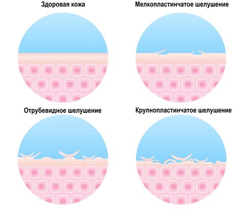Сухость и шелушение кожи