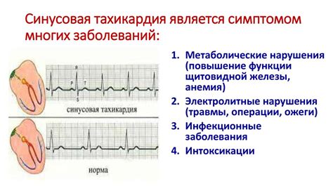 Тахикардия - распространенное заболевание сердца