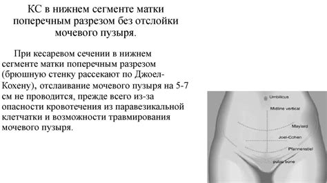 Техника кесарева сечения