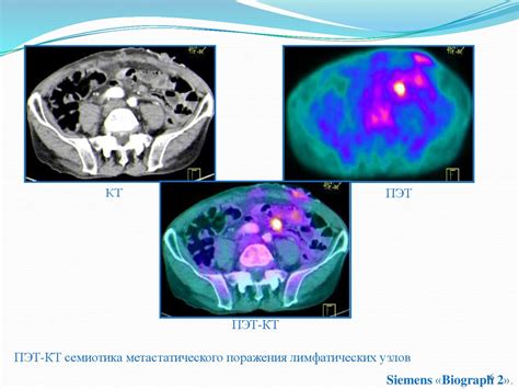 Точность обнаружения метастазов при Компьютерной Томографии