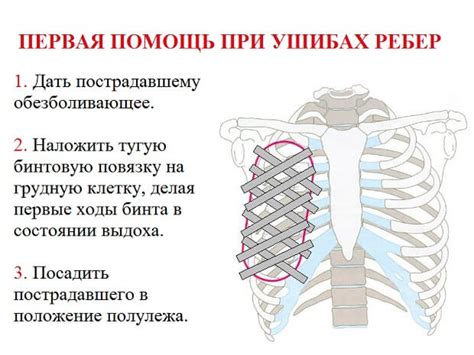 Трещина в ребре: общая информация