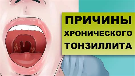 Узнайте причины тошноты при тонзиллите