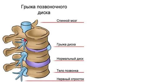 Улучшение кровообращения и обменных процессов в области грыжи позвоночника